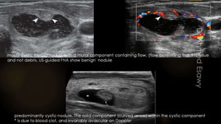 Thyroid ultrasound all things you should know part b