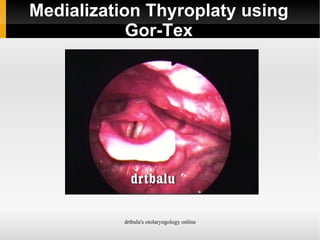 Medialization Thyroplaty using Gor-Tex 