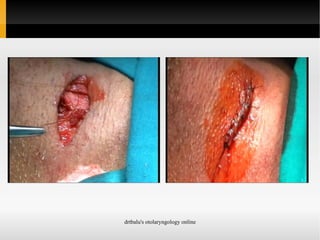 Poor abduction of contralateral vocal fold as this could compromise the airway 