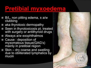 Pretibial myxoedema
 B/L, non pitting edema, ± a/w
clubbing
 aka thyrotoxic dermopathy
 Seen in thyrotoxicosis pt. treated
with surgery or antithyroid drugs
 Always a/w exophthalmos
 Cause : deposition of
myxomatous tissue(GAG’s)
mainly in pretibial region
 Skin – dry coarse and swelling
due to obliterated lymphatics by
mucin
 