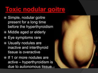 Toxic nodular goitre
 Simple, nodular goitre
present for a long time
before the hyperthyroidism
 Middle aged or elderly
 Eye symptoms rare
 Usually nodules are
inactive and interthyroid
tissue is overactive
 If 1 or more nodules are
active – hyperthyroidism is
due to autonomous tissue
 