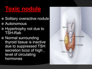 Toxic nodule
 Solitary overactive nodule
 Autonomous
 Hypertrophy not due to
TSH-Rab
 Normal surrounding
thyroid tissue is inactive
due to suppressed TSH
secretion bcoz of high ,
level of circulating
hormones
 