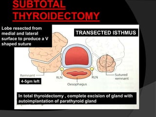 i
SUBTOTAL
THYROIDECTOMY
TRANSECTED ISTHMUS
Lobe resected from
medial and lateral
surface to produce a V
shaped suture
4-5gm left
In total thyroidectomy , complete excision of gland with
autoimplantation of parathyroid gland
 