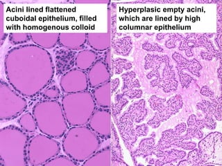 Acini lined flattened
cuboidal epithelium, filled
with homogenous colloid
Hyperplasic empty acini,
which are lined by high
columnar epithelium
 