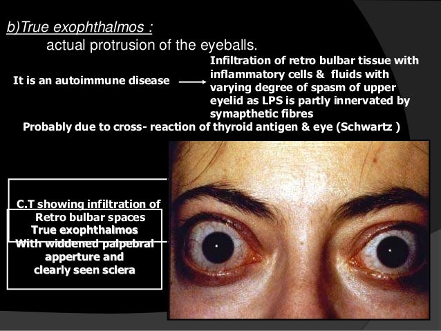 Thyrotoxicosis