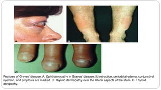 Features of Graves’ disease. A. Ophthalmopathy in Graves’ disease; lid retraction, periorbital edema, conjunctival
injection, and proptosis are marked. B. Thyroid dermopathy over the lateral aspects of the shins. C. Thyroid
acropachy.
 