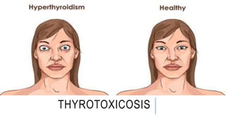 THYROTOXICOSIS
 