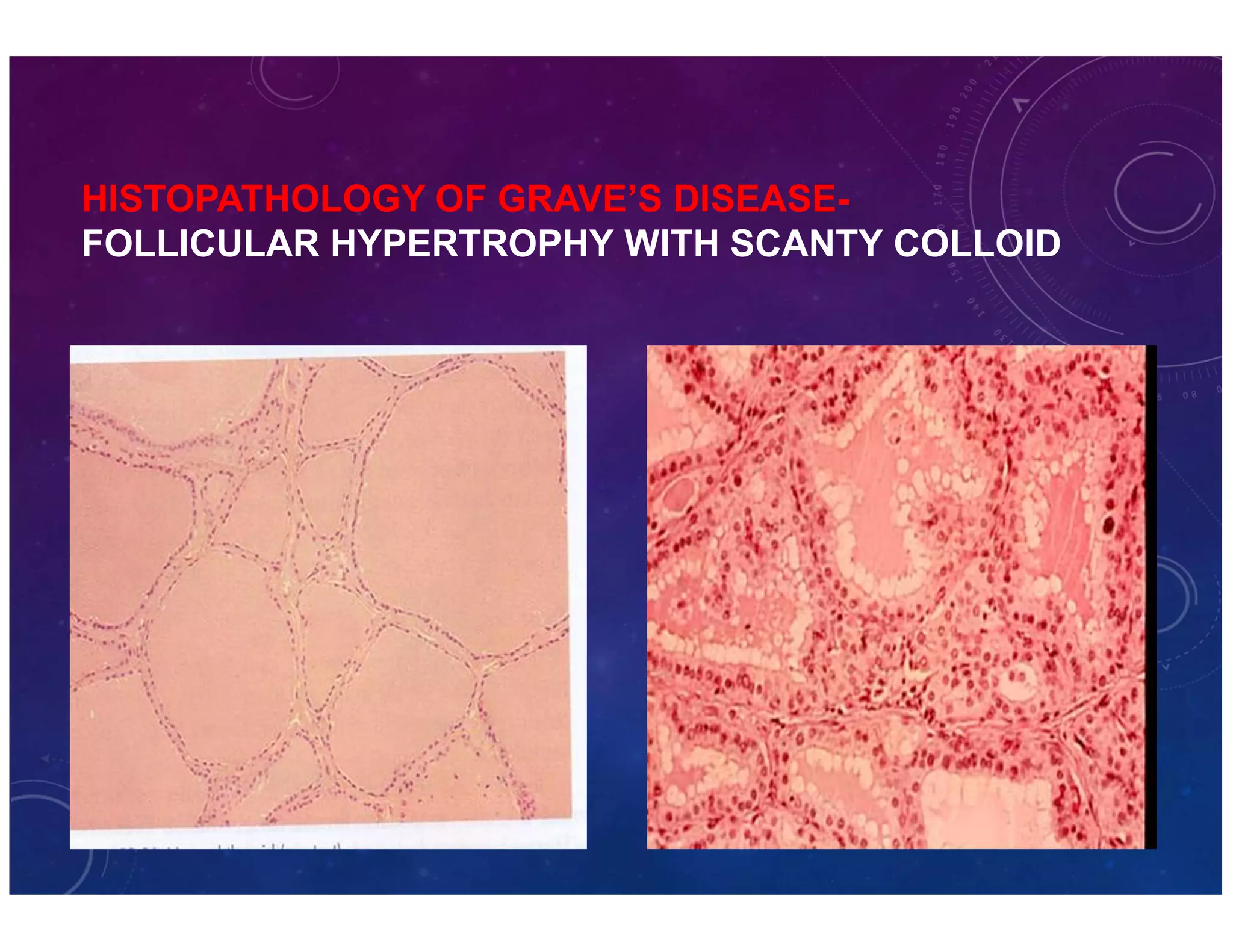 HISTOPATHOLOGY OF GRAVE’S DISEASE-FOLLICULAR 
HYPERTROPHY WITH SCANTY COLLOID 
 