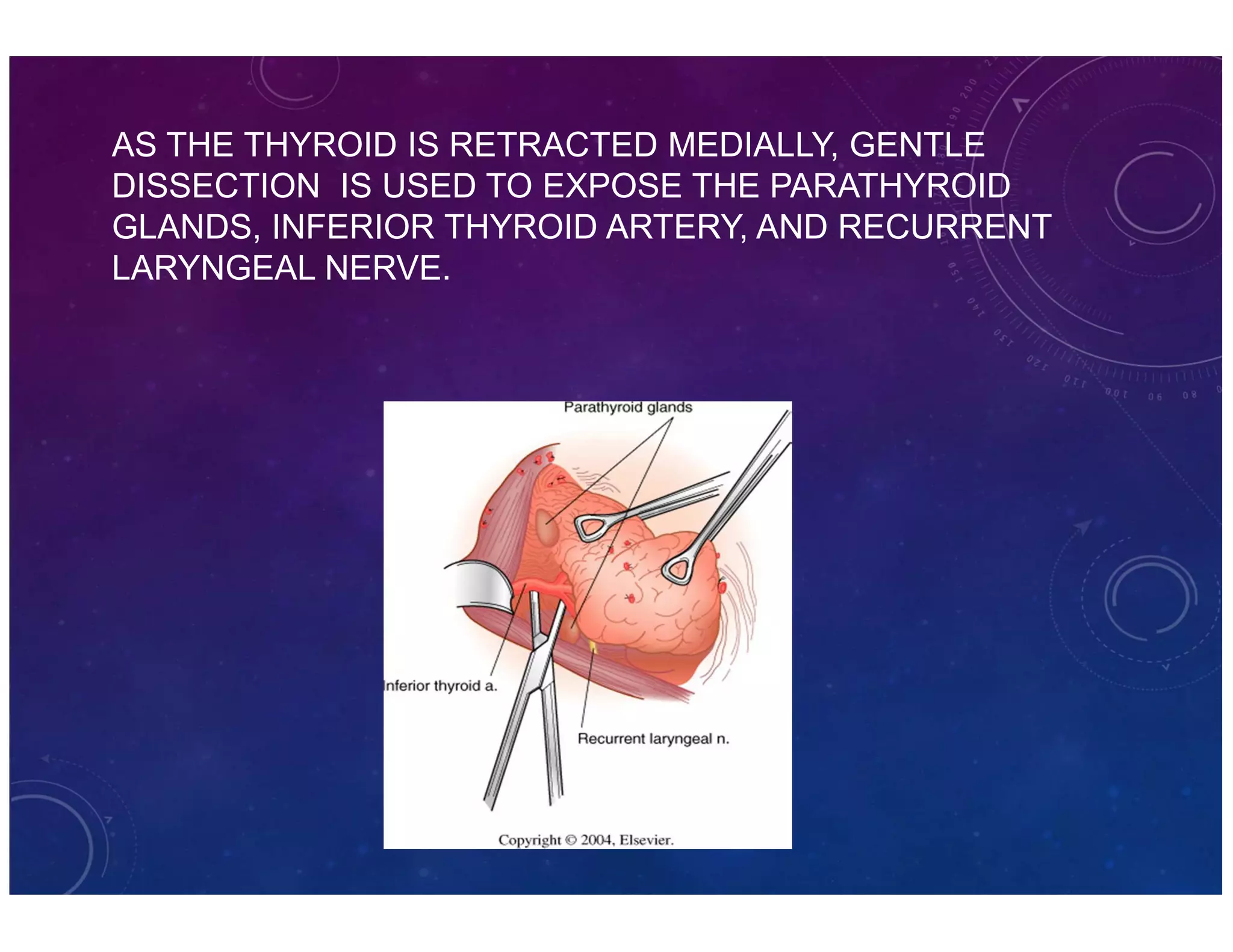 AS THE THYROID IS RETRACTED MEDIALLY, GENTLE 
DISSECTION IS USED TO EXPOSE THE PARATHYROID 
GLANDS, INFERIOR THYROID ARTERY, AND RECURRENT 
LARYNGEAL NERVE. 
 