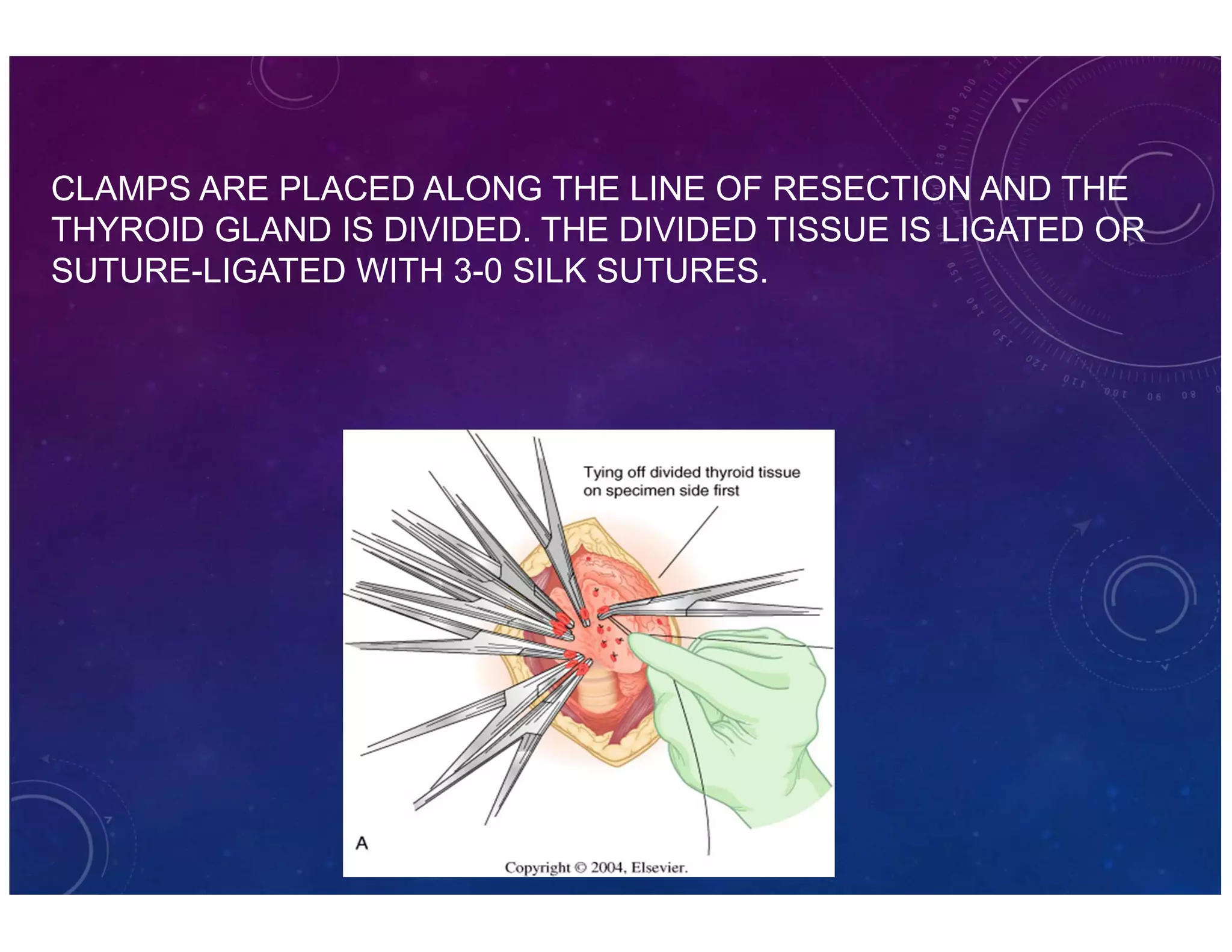 CLAMPS ARE PLACED ALONG THE LINE OF RESECTION AND THE 
THYROID GLAND IS DIVIDED. THE DIVIDED TISSUE IS LIGATED OR 
SUTURE-LIGATED WITH 3-0 SILK SUTURES. 
 
