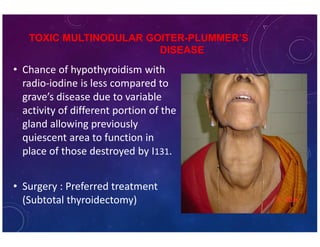 Thyroid- Benign swellings | PDF