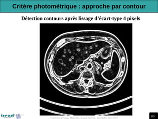 105
Traitement d'Images Médicales, Arnaud Charnoz, Ircad R&D 2012-2013
Détection contours après lissage d’écart-type 4 pixels
Critère photométrique : approche par contour
 