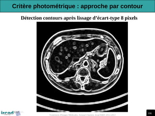 106
Traitement d'Images Médicales, Arnaud Charnoz, Ircad R&D 2012-2013
Détection contours après lissage d’écart-type 8 pixels
Critère photométrique : approche par contour
 