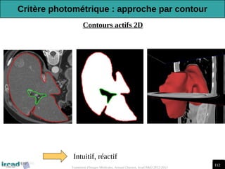 112
Traitement d'Images Médicales, Arnaud Charnoz, Ircad R&D 2012-2013
Contours actifs 2D
Intuitif, réactif
Critère photométrique : approche par contour
 