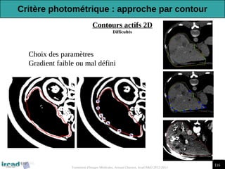 116
Traitement d'Images Médicales, Arnaud Charnoz, Ircad R&D 2012-2013
Contours actifs 2D
Difficultés
-Choix des paramètres
-Gradient faible ou mal défini
Critère photométrique : approche par contour
 