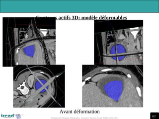 122
Traitement d'Images Médicales, Arnaud Charnoz, Ircad R&D 2012-2013
Avant déformation
Contours actifs 3D: modèle déformables
 