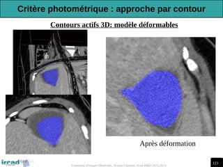 123
Traitement d'Images Médicales, Arnaud Charnoz, Ircad R&D 2012-2013
Après déformation
Contours actifs 3D: modèle déformables
Critère photométrique : approche par contour
 