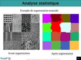133
Traitement d'Images Médicales, Arnaud Charnoz, Ircad R&D 2012-2013
Exemple de segmentation texturale
Avant segmentation Après segmentation
Analyse statistique
 