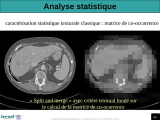 134
Traitement d'Images Médicales, Arnaud Charnoz, Ircad R&D 2012-2013
caractérisation statistique texturale classique : matrice de co-occurrence
« Split and merge » avec critère textural fondé sur
le calcul de la matrice de co-ocurrence
Analyse statistique
 