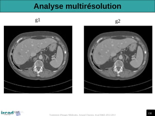 138
Traitement d'Images Médicales, Arnaud Charnoz, Ircad R&D 2012-2013
g1 g2
Analyse multirésolution
 