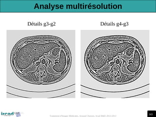 143
Traitement d'Images Médicales, Arnaud Charnoz, Ircad R&D 2012-2013
Détails g3-g2 Détails g4-g3
Analyse multirésolution
 