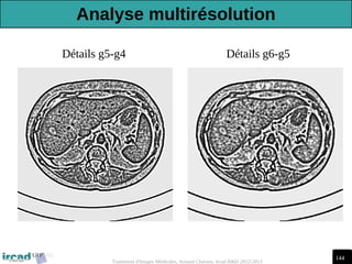 144
Traitement d'Images Médicales, Arnaud Charnoz, Ircad R&D 2012-2013
Détails g5-g4 Détails g6-g5
Analyse multirésolution
 
