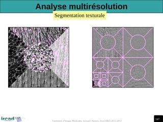 147
Traitement d'Images Médicales, Arnaud Charnoz, Ircad R&D 2012-2013
Segmentation texturale
Analyse multirésolution
 