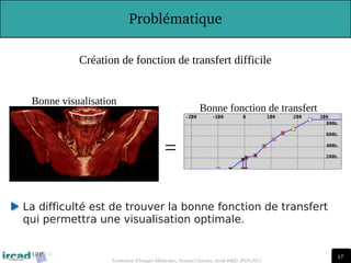 17
17
Traitement d'Images Médicales, Arnaud Charnoz, Ircad R&D 2010-2011
 
Problématique
La difficulté est de trouver la bonne fonction de transfert
qui permettra une visualisation optimale.
Bonne visualisation
Bonne fonction de transfert
=
Création de fonction de transfert difficile
 