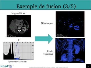 20
20
Traitement d'Images Médicales, Arnaud Charnoz, Ircad R&D 2010-2011
 
Exemple de fusion (3/5)
+
Fonction de transfert
Image médicale
Négatoscope
Rendu
volumique
 