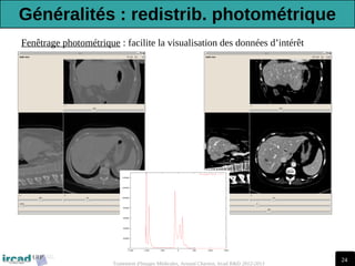 24
Traitement d'Images Médicales, Arnaud Charnoz, Ircad R&D 2012-2013
Fenêtrage photométrique : facilite la visualisation des données d’intérêt
Généralités : redistrib. photométrique
 
