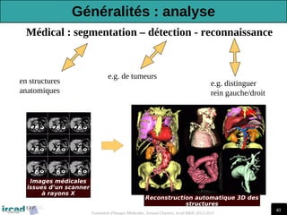 40
Traitement d'Images Médicales, Arnaud Charnoz, Ircad R&D 2012-2013
Reconstruction automatique 3D des
structures
Images médicales
issues d’un scanner
à rayons X
Médical : segmentation – détection - reconnaissance
en structures
anatomiques
e.g. de tumeurs
e.g. distinguer
rein gauche/droit
Généralités : analyse
 