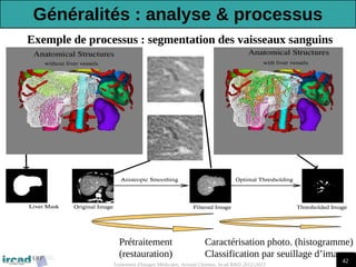 42
Traitement d'Images Médicales, Arnaud Charnoz, Ircad R&D 2012-2013
Prétraitement
(restauration)
Caractérisation photo. (histogramme)
Classification par seuillage d’image
Exemple de processus : segmentation des vaisseaux sanguins
Généralités : analyse & processus
 