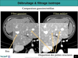 54
Traitement d'Images Médicales, Arnaud Charnoz, Ircad R&D 2012-2013
Filtre médian
Filtre gaussien
flou
Disparition des petites structures
Comparaison gaussien/médian
Débruitage & filtrage isotrope
 