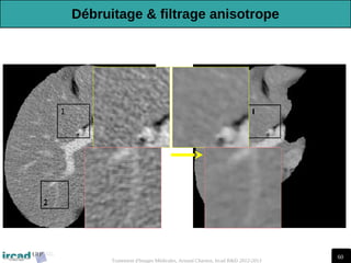 60
Traitement d'Images Médicales, Arnaud Charnoz, Ircad R&D 2012-2013
Débruitage & filtrage anisotrope
 