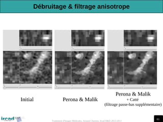 61
Traitement d'Images Médicales, Arnaud Charnoz, Ircad R&D 2012-2013
Perona & Malik
Initial
Perona & Malik
+ Catté
(filtrage passe-bas supplémentaire)
Débruitage & filtrage anisotrope
 