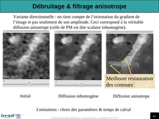62
Traitement d'Images Médicales, Arnaud Charnoz, Ircad R&D 2012-2013
Variante directionnelle : on tient compte de l’orientation du gradient de
l’image et pas seulement de son amplitude. Ceci correspond à la véritable
diffusion anisotrope (celle de PM est dite scalaire inhomogène).
Initial Diffusion anisotrope
Diffusion inhomogène
Meilleure restauration
des contours
Limitations : choix des paramètres & temps de calcul
Débruitage & filtrage anisotrope
 