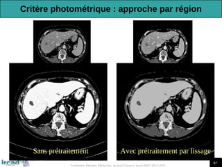 87
Traitement d'Images Médicales, Arnaud Charnoz, Ircad R&D 2012-2013
Sans prétraitement Avec prétraitement par lissage
Critère photométrique : approche par région
 