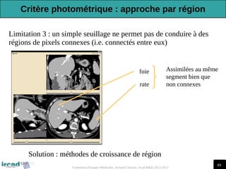 89
Traitement d'Images Médicales, Arnaud Charnoz, Ircad R&D 2012-2013
Limitation 3 : un simple seuillage ne permet pas de conduire à des
régions de pixels connexes (i.e. connectés entre eux)
Solution : méthodes de croissance de région
foie
rate
Assimilées au même
segment bien que
non connexes
Critère photométrique : approche par région
 
