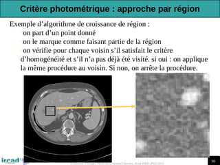 90
Traitement d'Images Médicales, Arnaud Charnoz, Ircad R&D 2012-2013
Exemple d’algorithme de croissance de région :
•on part d’un point donné
•on le marque comme faisant partie de la région
•on vérifie pour chaque voisin s’il satisfait le critère
d’homogénéité et s’il n’a pas déjà été visité. si oui : on applique
la même procédure au voisin. Si non, on arrête la procédure.
Critère photométrique : approche par région
 