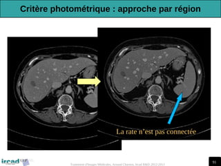 91
Traitement d'Images Médicales, Arnaud Charnoz, Ircad R&D 2012-2013
La rate n’est pas connectée
Critère photométrique : approche par région
 