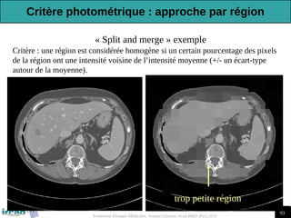 93
Traitement d'Images Médicales, Arnaud Charnoz, Ircad R&D 2012-2013
« Split and merge » exemple
Critère : une région est considérée homogène si un certain pourcentage des pixels
de la région ont une intensité voisine de l’intensité moyenne (+/- un écart-type
autour de la moyenne).
trop petite région
Critère photométrique : approche par région
 