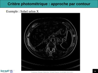 98
Traitement d'Images Médicales, Arnaud Charnoz, Ircad R&D 2012-2013
•Exemple : Sobel selon X
Critère photométrique : approche par contour
 