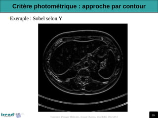 99
Traitement d'Images Médicales, Arnaud Charnoz, Ircad R&D 2012-2013
•Exemple : Sobel selon Y
Critère photométrique : approche par contour
 