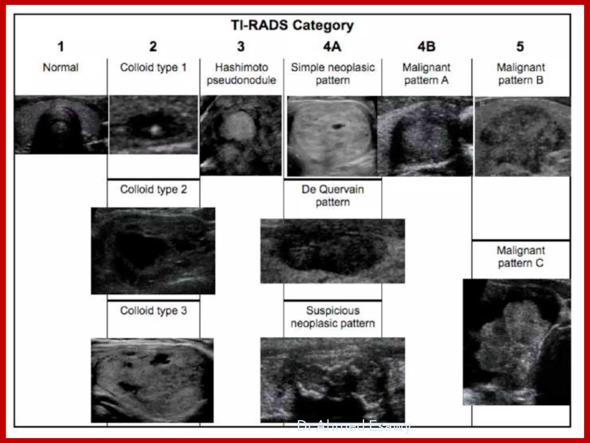 TIRADS (thyroid nodule imaging reporting and data system) Dr Ahmed ...