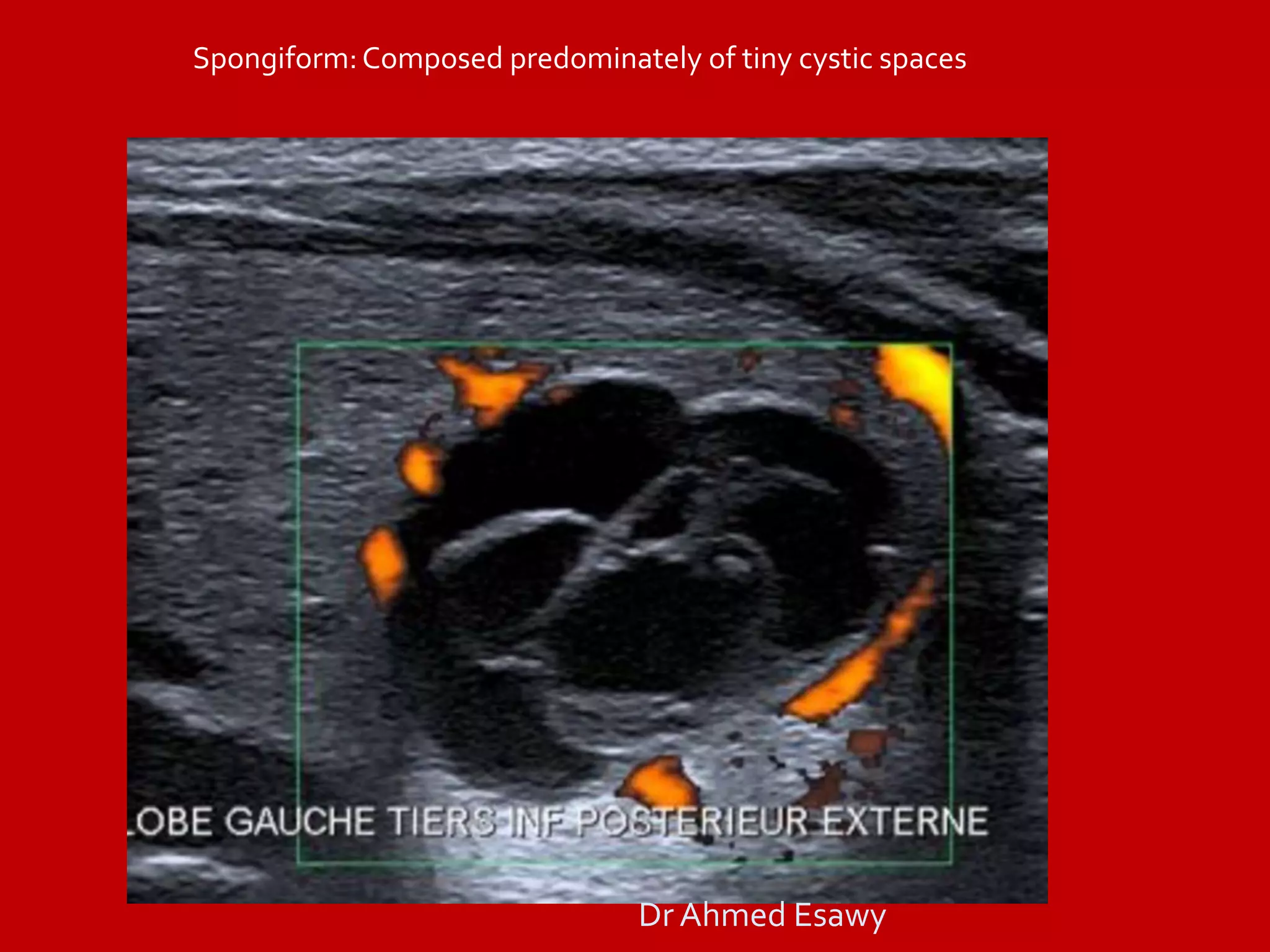 TIRADS (thyroid nodule imaging reporting and data system) Dr Ahmed ...