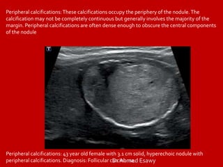 Peripheral Calcification TIRADS (thyroid nodule imaging reporting and data system) Dr Ahmed ...