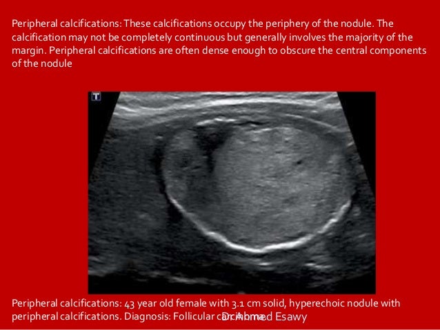 Colloid thyroid nodule with calcium