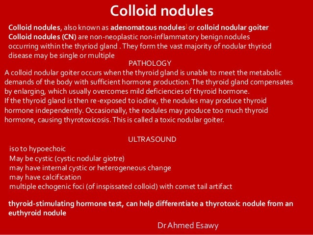 Colloid thyroid nodule with calcium