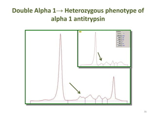 Double Alpha 1->Heterozygousphenotype of alpha 1 antitrypsin36