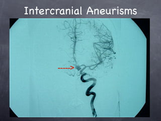 Intercranial Aneurisms
 